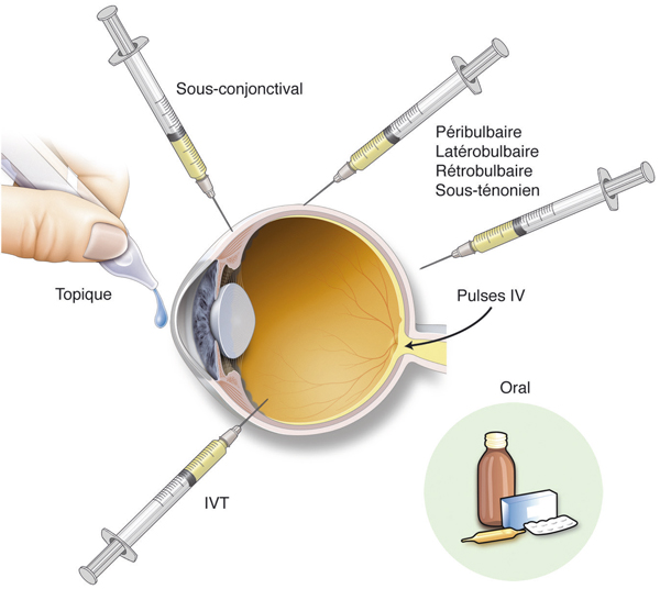 Optique Distribution - RetiJet® Indications : Injection d'huile de