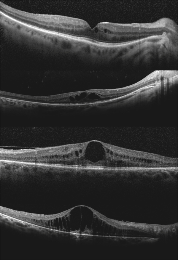 Rapport Sfo 2016 œdemes Maculaires