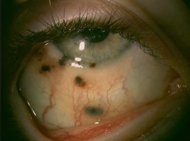 Rapport Sfo 17 Ophtalmologie Pediatrique