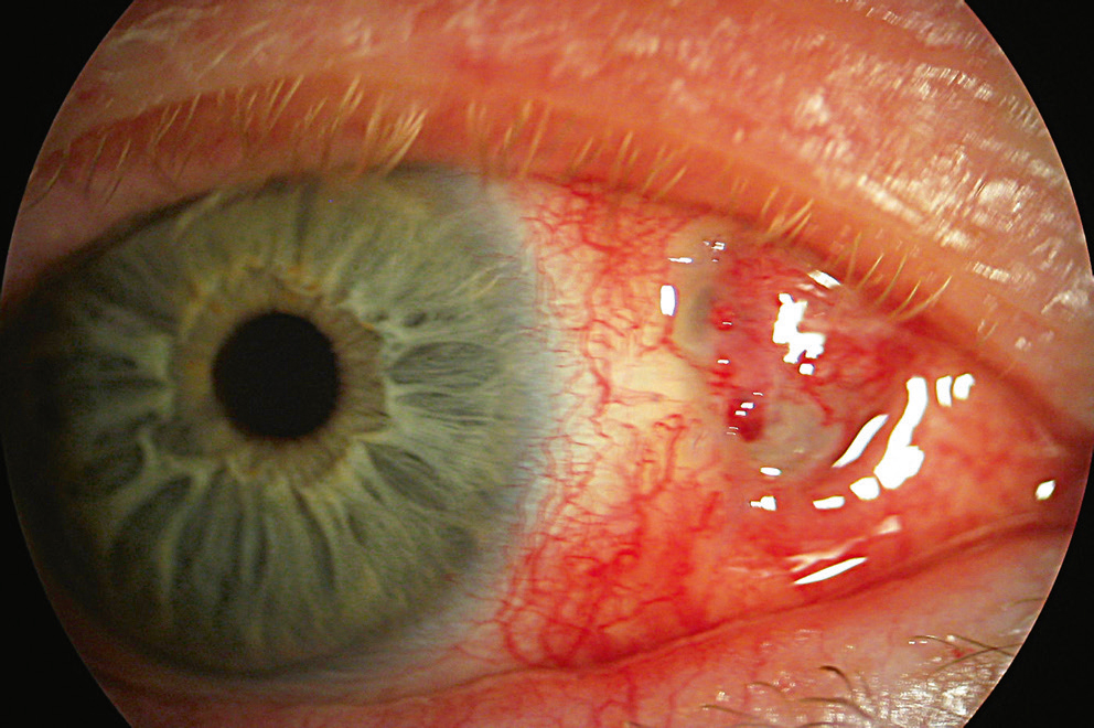 sclera de pigmentare oftalmologie plus șase viziuni