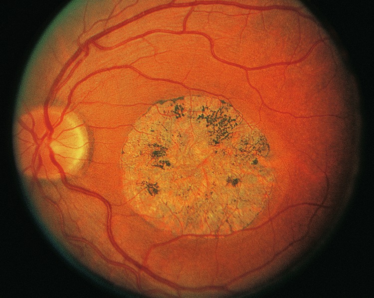 Rapport Sfo 2018 Retine Et Vitre